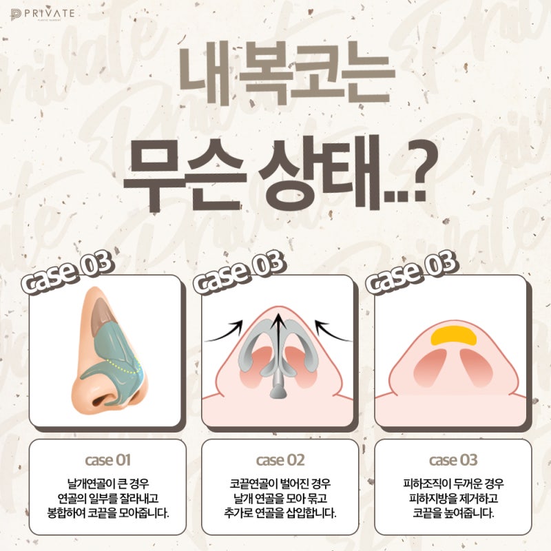 신사복코성형수술로 세련된 라인을 확인해보세요 사진 5