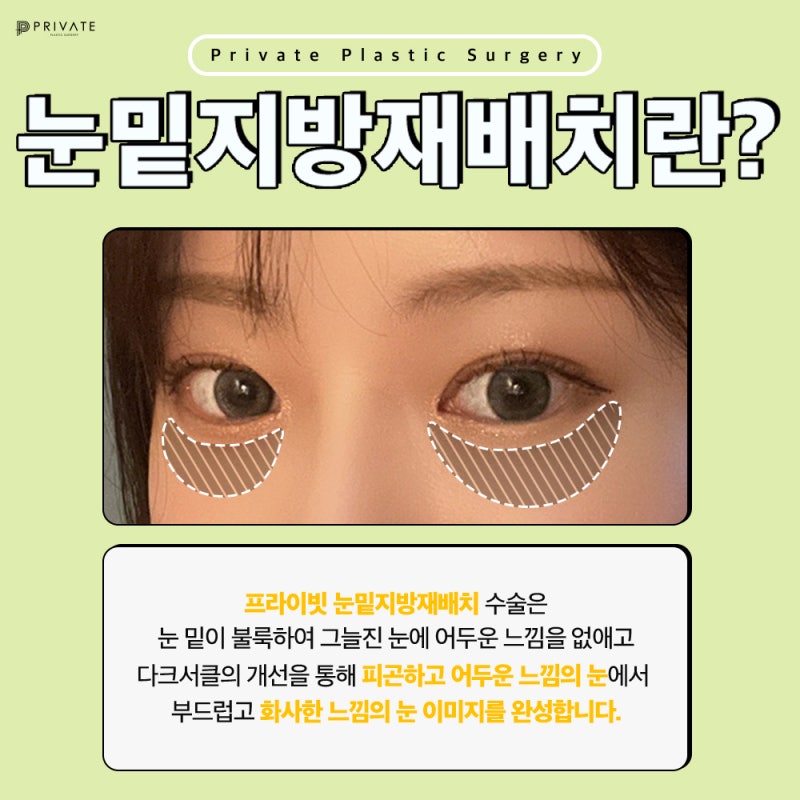 Sinsa Under-Eye Fat Repositioning: Where to Get It Done Well 사진 3