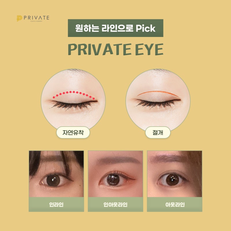 Achieving Proportion with Double Eyelid Revision Surgery at a Reputable Clinic 사진 4