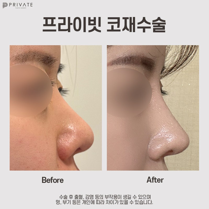 Nose Revision Surgery Review: Private Plastic Surgery Clinic 사진 8