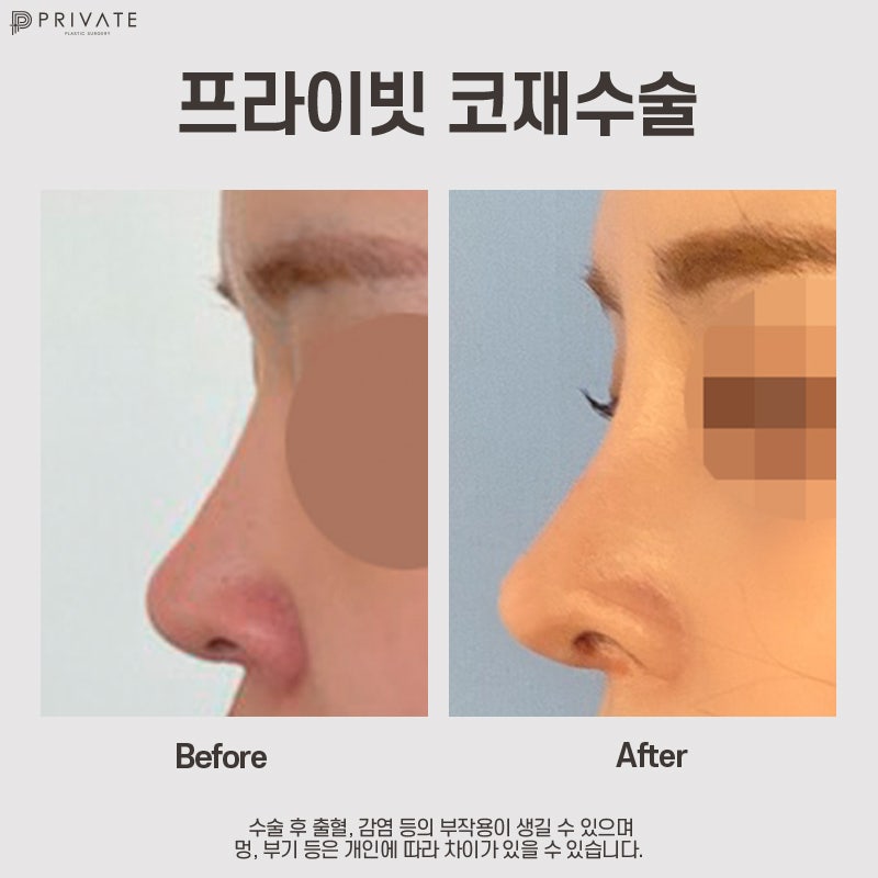 Nose Revision Surgery Review: Private Plastic Surgery Clinic 사진 2