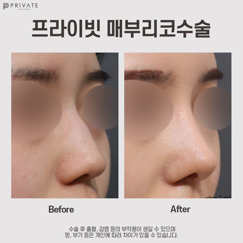 Operasi Hidung Bengkok di Private Plastic Surgery 사진 2