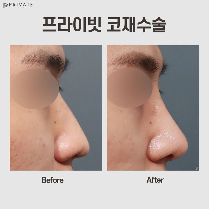 Nose Revision Surgery at Private Plastic Surgery Clinic 사진 9