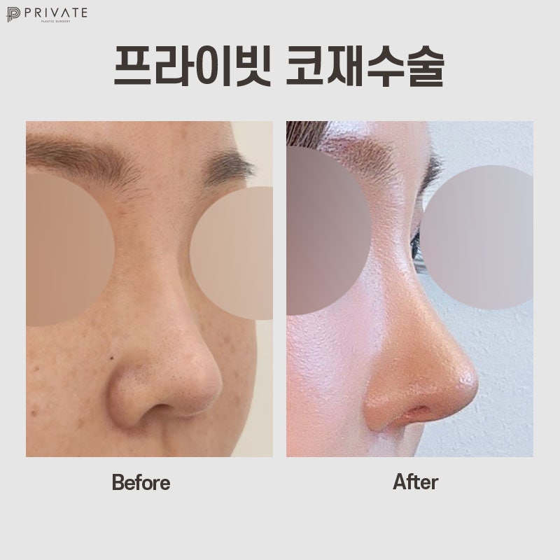 Nose Revision Surgery at Private Plastic Surgery Clinic 사진 2
