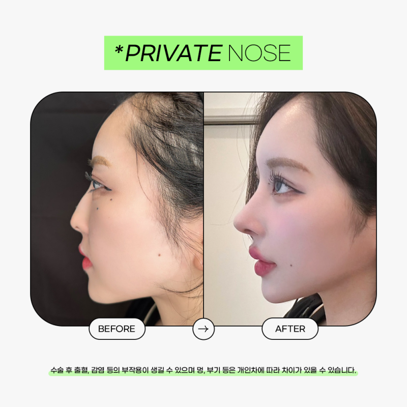 Private Plastic Surgery Clinic: Always Recruiting Plastic Surgery Models and Real Models 사진 8