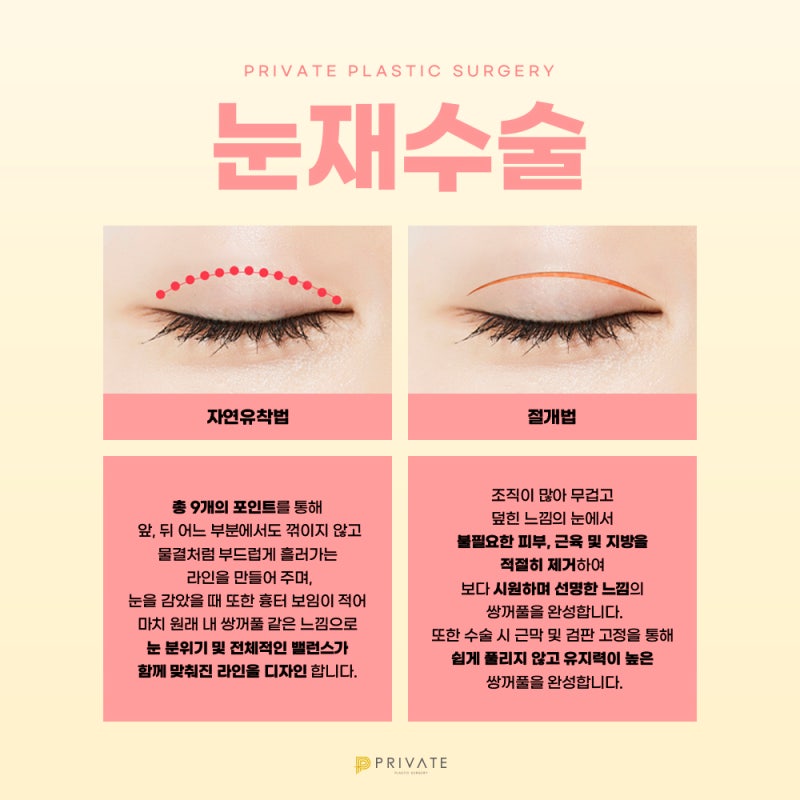 Ulasan Bedah Rekonstruksi Mata di Private Plastic Surgery 사진 4