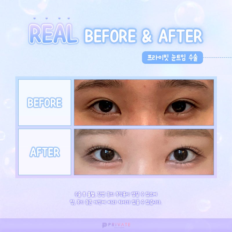 Operasi Pembukaan Mata yang Rapi dan Bagus di Private Plastic Surgery 사진 5