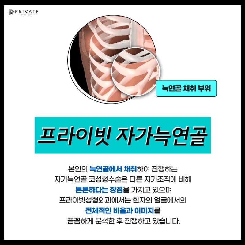 자가늑 코재수술 후기 많은곳 프라이빗성형외과