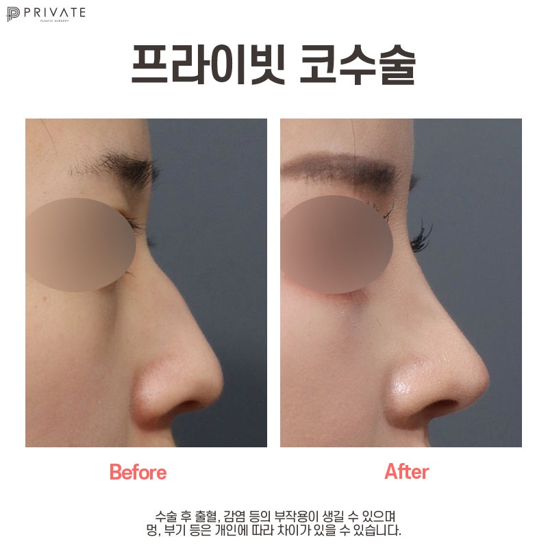 The Magic of Transformation with Hooked Nose Correction at Private Plastic Surgery 사진 10
