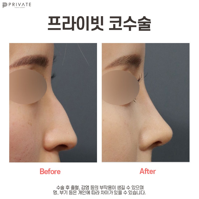 The Magic of Transformation with Hooked Nose Correction at Private Plastic Surgery 사진 7