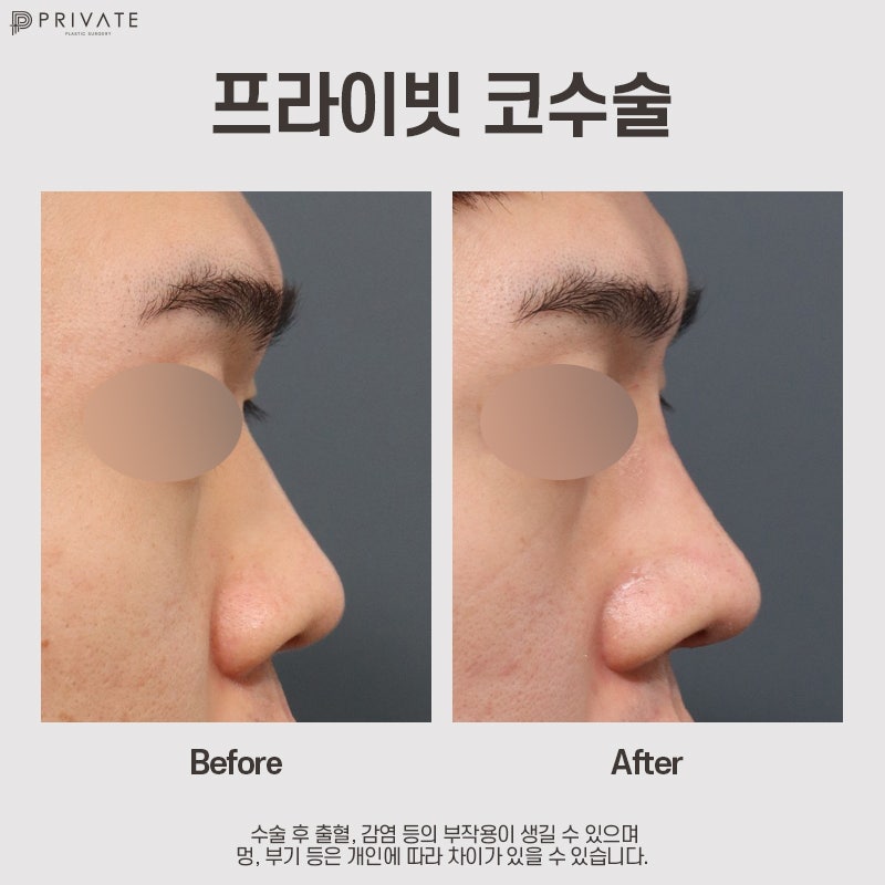 Private Plastic Surgery, Hasil Operasi Hidung Pria yang Bagus 사진 7