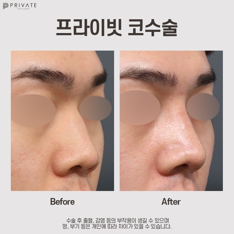 Private Plastic Surgery, Hasil Operasi Hidung Pria yang Bagus 사진 8