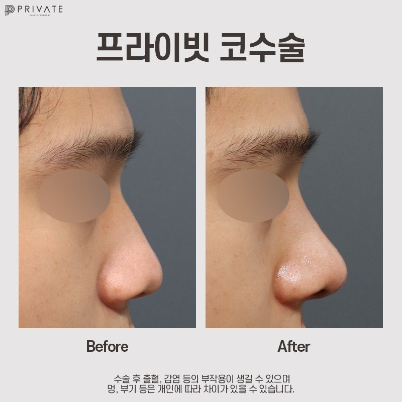 Private Plastic Surgery, Hasil Operasi Hidung Pria yang Bagus 사진 9