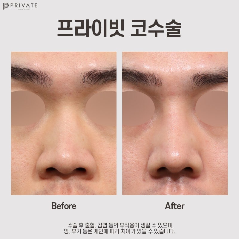 Private Plastic Surgery, Hasil Operasi Hidung Pria yang Bagus 사진 6