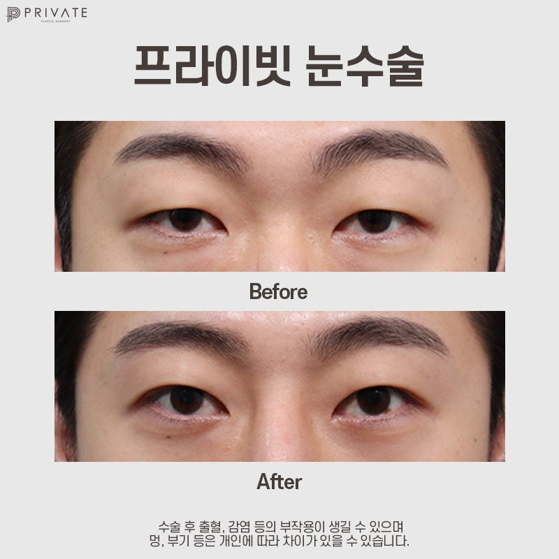 Operasi Sayatan Kelopak Mata Ganda Pria di Private Plastic Surgery 사진 9
