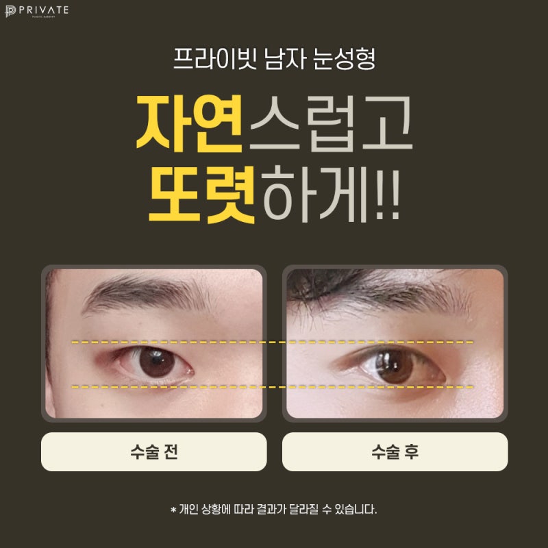 Operasi Sayatan Kelopak Mata Ganda Pria di Private Plastic Surgery 사진 5