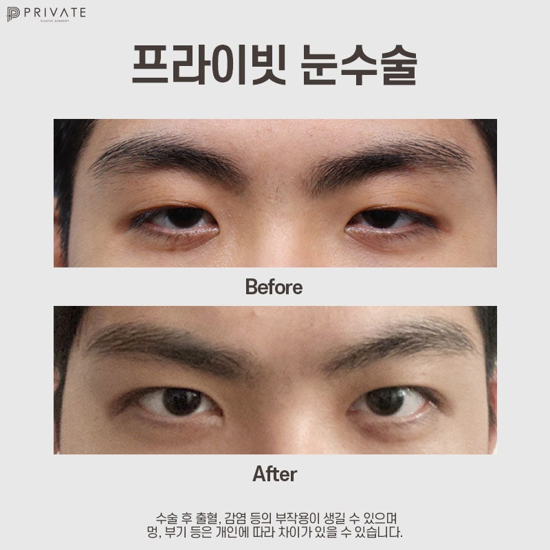 Operasi Sayatan Kelopak Mata Ganda Pria di Private Plastic Surgery 사진 10