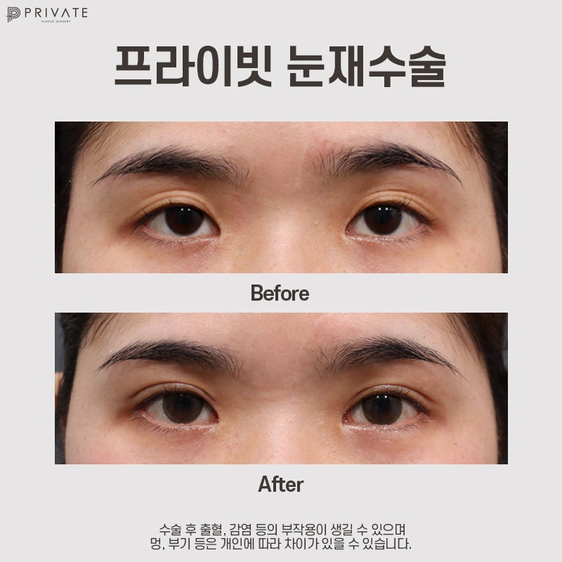 Sinsa Private Plastic Surgery: The Best Place for Eye Reoperation 사진 8