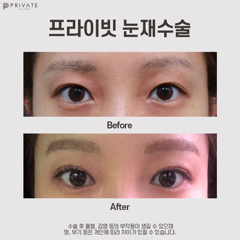 Sinsa Private Plastic Surgery: The Best Place for Eye Reoperation 사진 9
