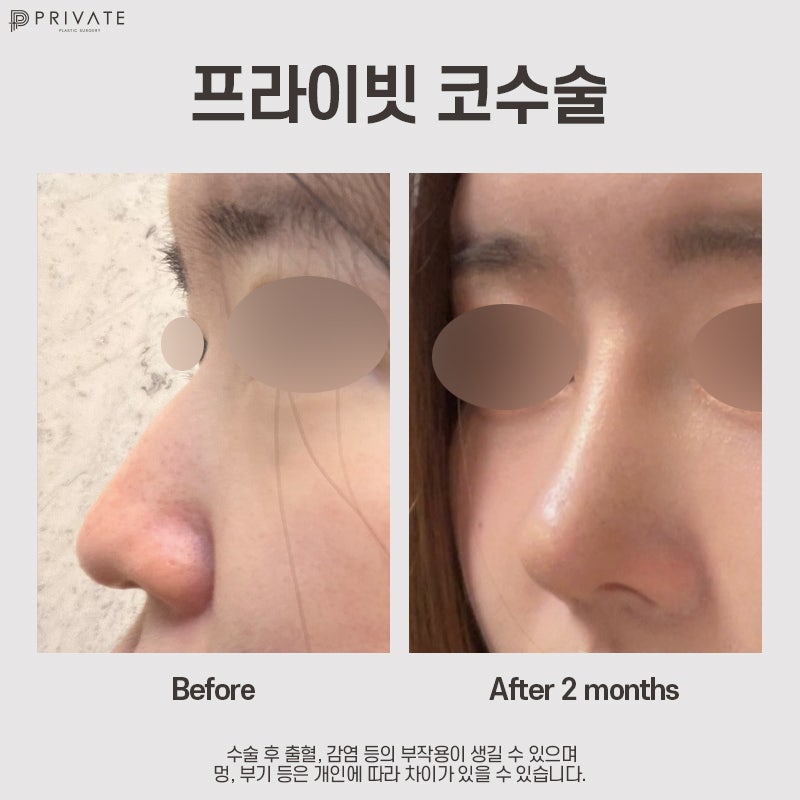 Nếu bạn đang cân nhắc phẫu thuật nâng mũi bằng sụn sườn tự thân, hãy đến Bệnh viện Thẩm mỹ Private 사진 11