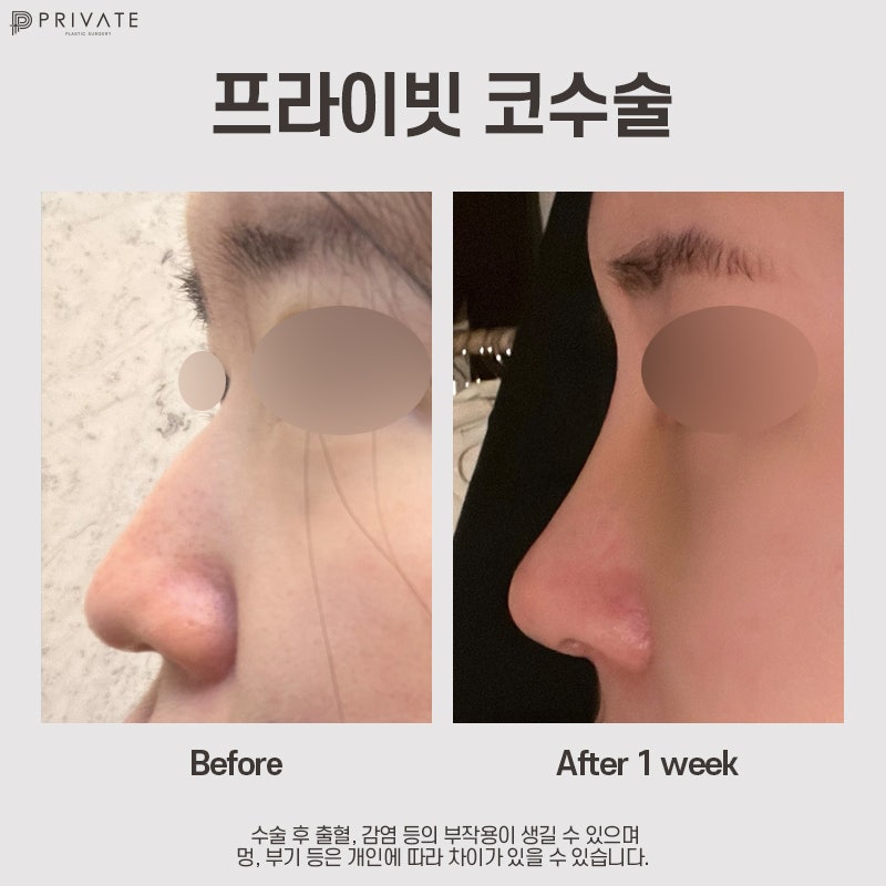Nếu bạn đang cân nhắc phẫu thuật nâng mũi bằng sụn sườn tự thân, hãy đến Bệnh viện Thẩm mỹ Private 사진 9