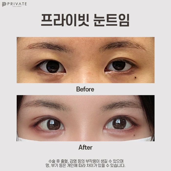 Sinsa Private Plastic Surgery: The Best Place for Canthoplasty 사진 9