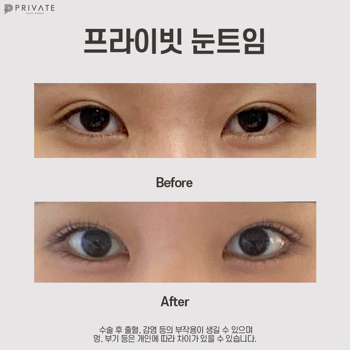 Sinsa Private Plastic Surgery: The Best Place for Canthoplasty 사진 10
