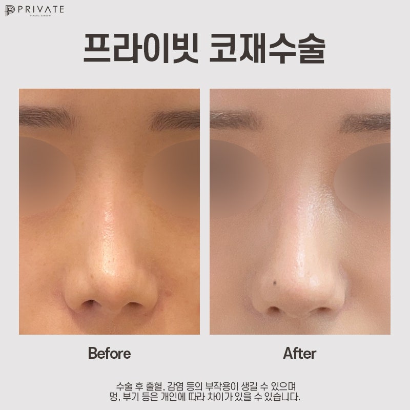 Considering Revision Rhinoplasty? Private Plastic Surgery Clinic 사진 11