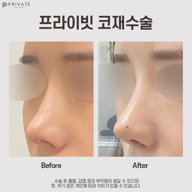 Considering Revision Rhinoplasty? Private Plastic Surgery Clinic 사진 10
