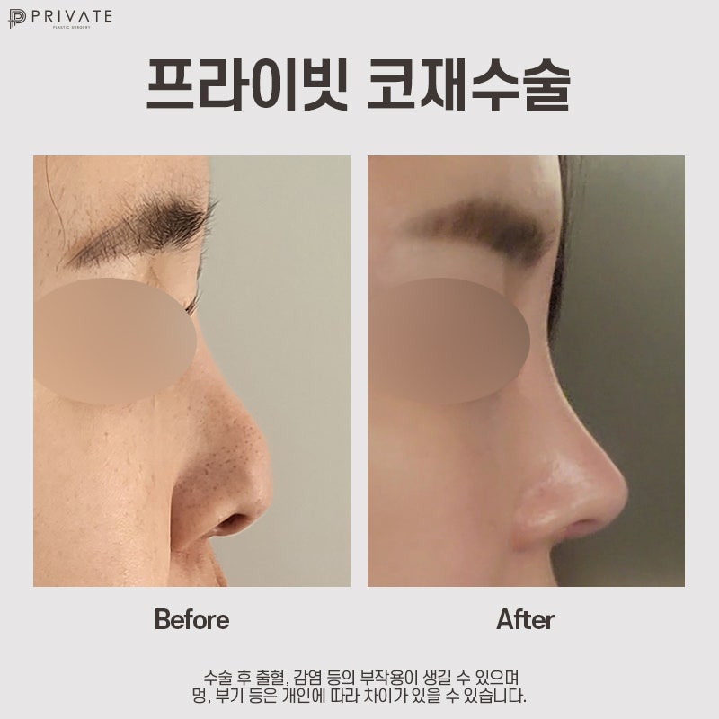 Considering Revision Rhinoplasty? Private Plastic Surgery Clinic 사진 8
