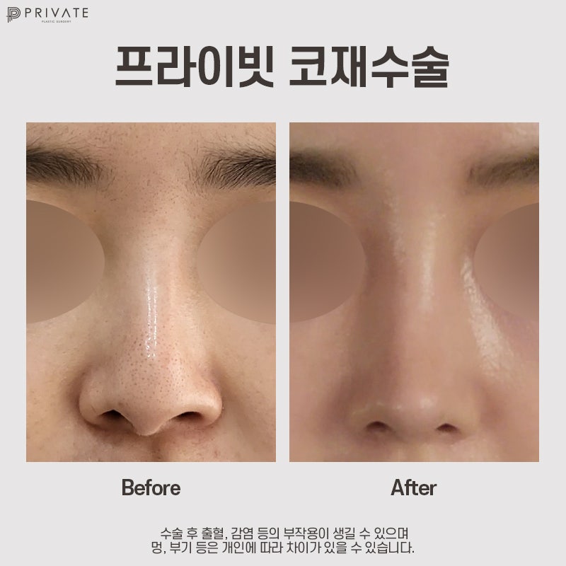 Considering Revision Rhinoplasty? Private Plastic Surgery Clinic 사진 9