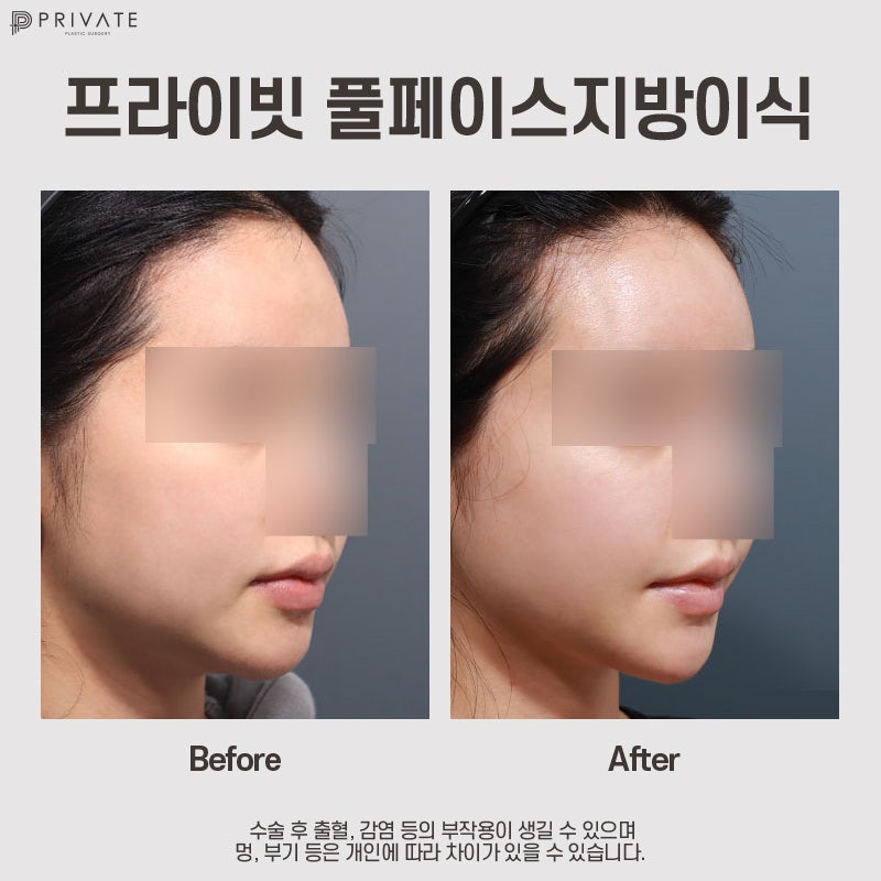 얼굴지방이식잘하는곳은 신사역 프라이빗성형외과 사진 11