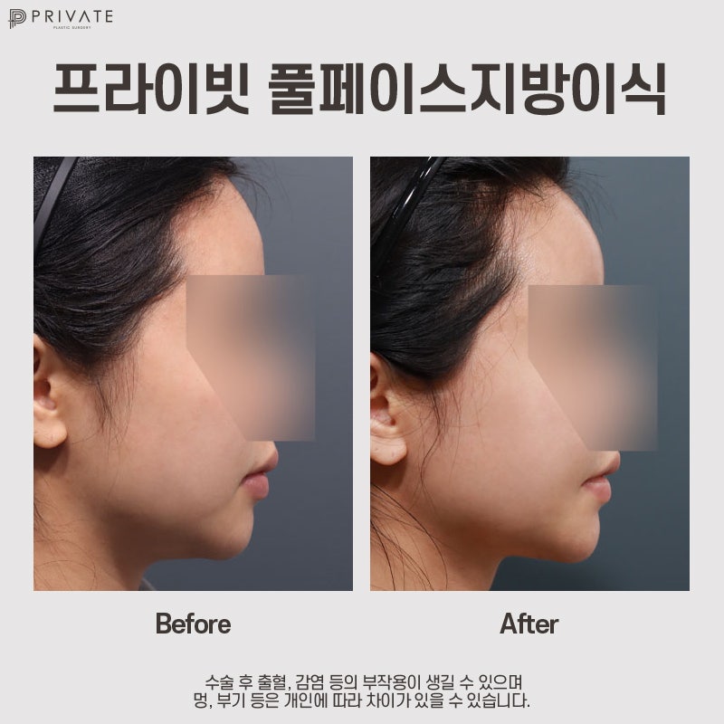 얼굴지방이식잘하는곳은 신사역 프라이빗성형외과 사진 12