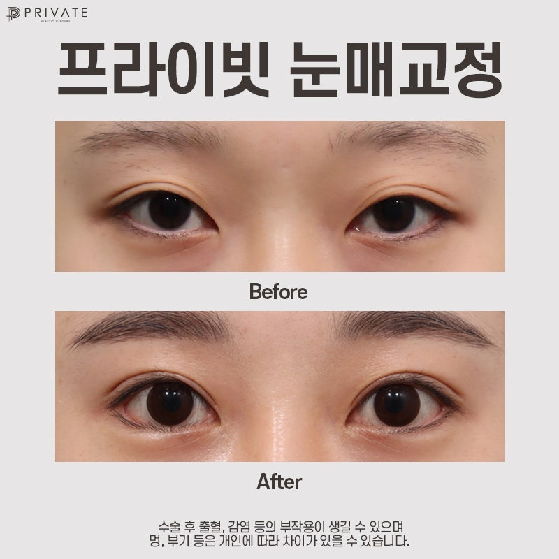 눈매교정수술전후 보정없는 프라이빗성형외과 사진 8