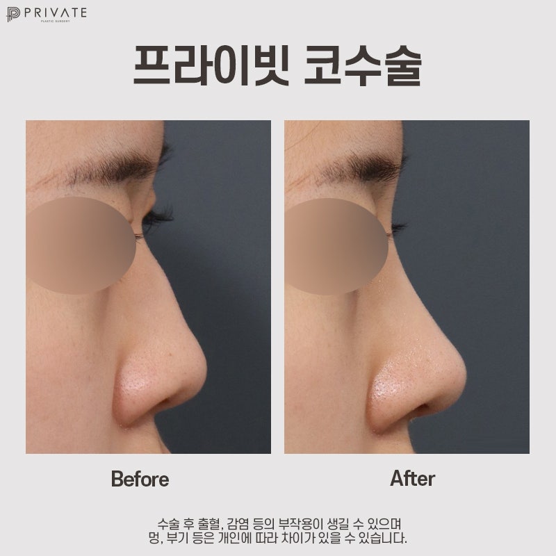 Private Plastic Surgery Clinic, Recommended for Nose Surgery 사진 12