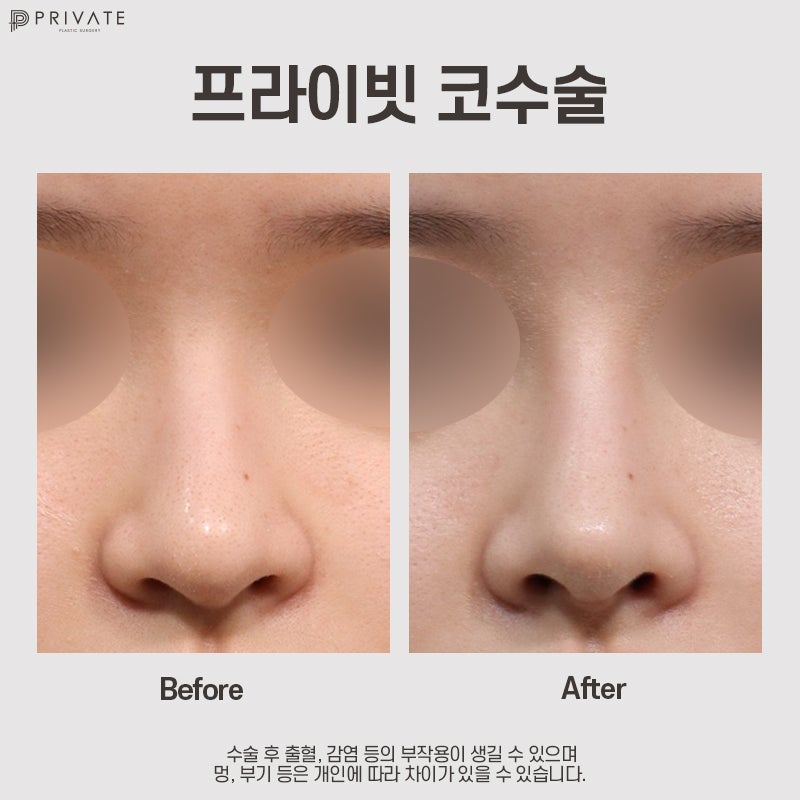 Private Plastic Surgery Clinic, Recommended for Nose Surgery 사진 8
