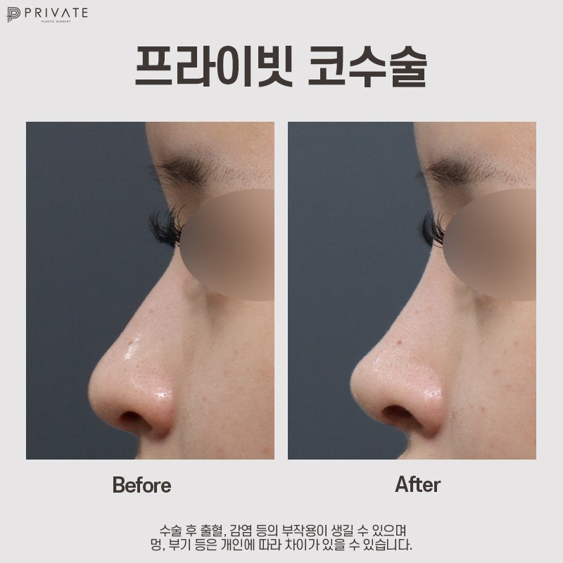 Private Plastic Surgery Clinic, Recommended for Nose Surgery 사진 10