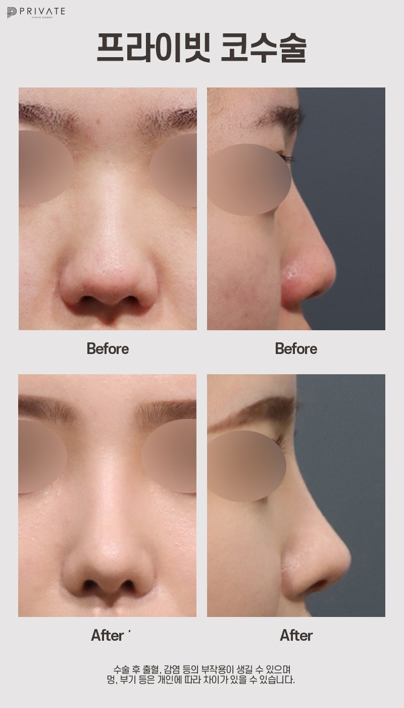Ulasan Operasi Hidung Babi di Private Plastic Surgery 사진 8