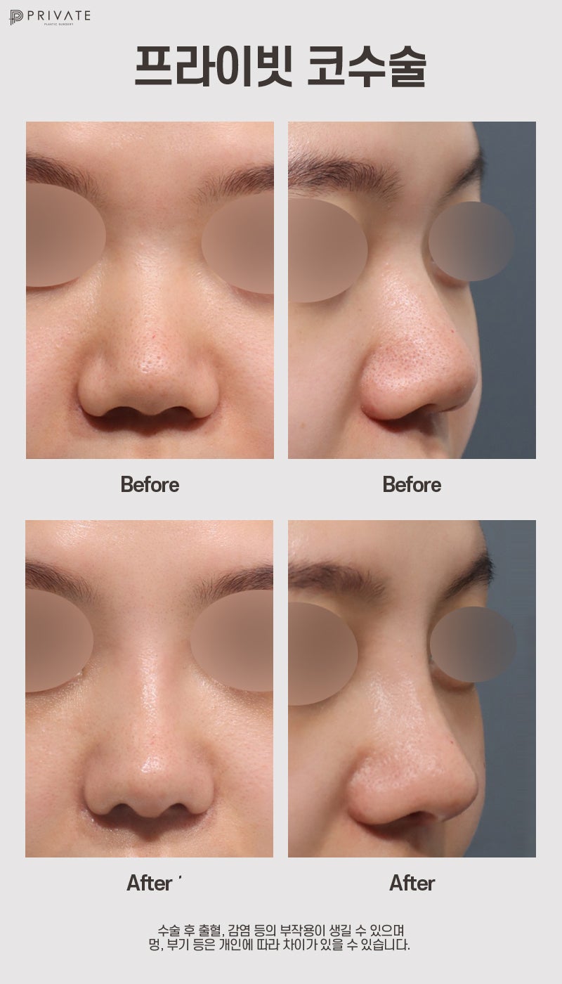 Ulasan Operasi Hidung Babi di Private Plastic Surgery 사진 9