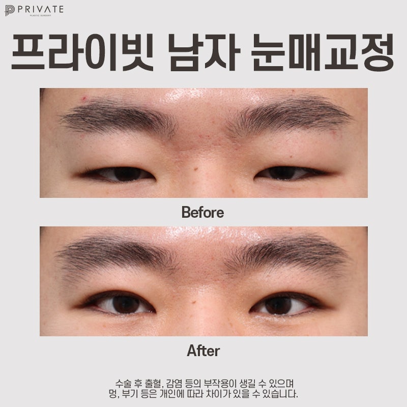 Private Plastic Surgery Clinic: Comparing Before & After Male Ptosis Correction 사진 5