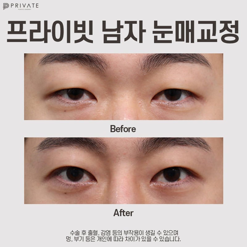 Private Plastic Surgery Clinic: Comparing Before & After Male Ptosis Correction 사진 4