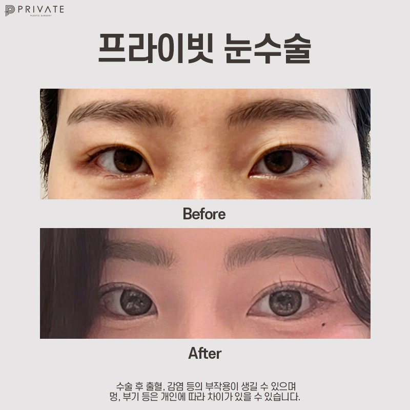 Private Plastic Surgery Clinic: Experts in Semi-Out Double Eyelid Surgery 사진 8
