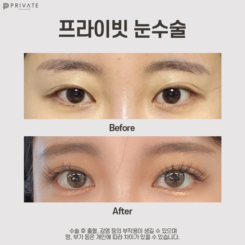 Private Plastic Surgery Clinic: Experts in Semi-Out Double Eyelid Surgery 사진 9