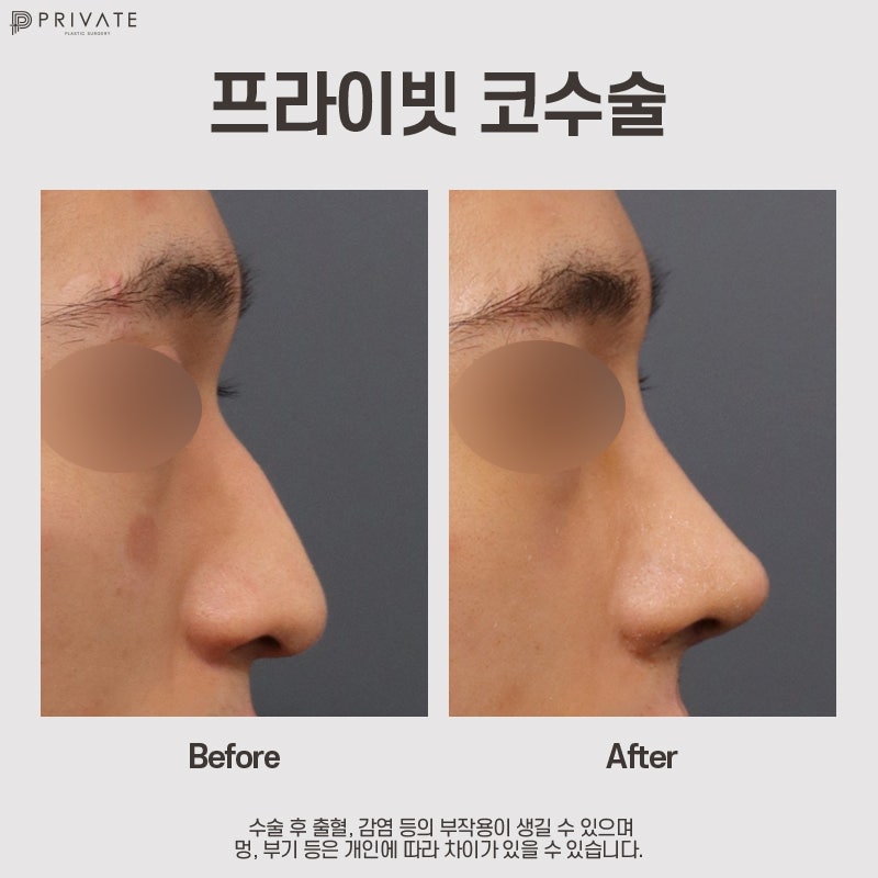 Penasaran dengan hasil operasi hidung pria? Private Plastic Surgery 사진 8