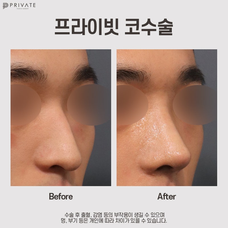 Penasaran dengan hasil operasi hidung pria? Private Plastic Surgery 사진 9