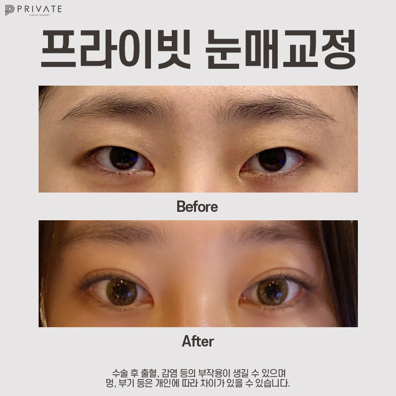 Private Plastic Surgery Clinic: The Best Place for Ptosis Correction and Double Eyelid Surgery 사진 10