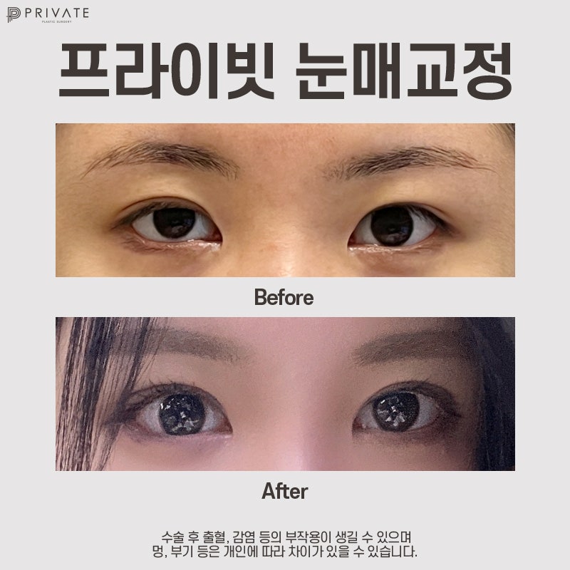 Private Plastic Surgery Clinic: The Best Place for Ptosis Correction and Double Eyelid Surgery 사진 9