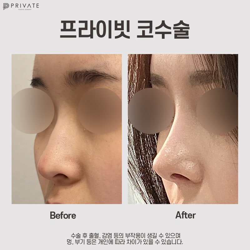 Ulasan Operasi Hidung Rendah di Private Plastic Surgery 사진 9