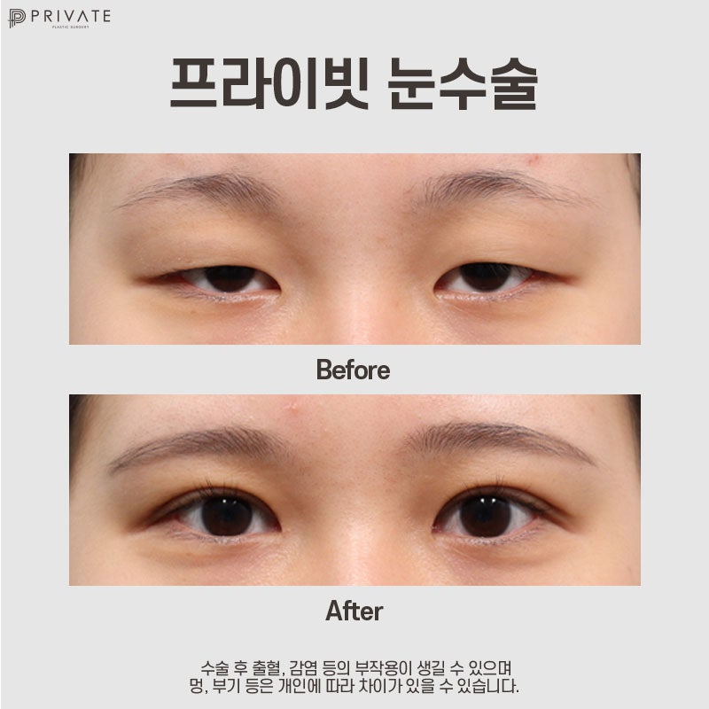 프라이빗성형외과 눈매교정수술후기 비교가 딱이야 사진 8