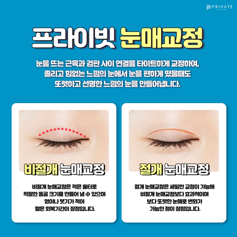 프라이빗성형외과 눈매교정수술후기 비교가 딱이야